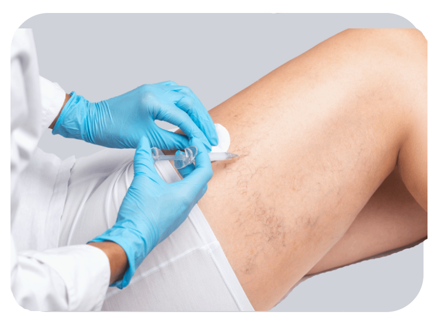 Sclerotherapy Canberra